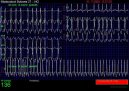 Koky:  > Fibrilace sn (Veterinrn zkroky)